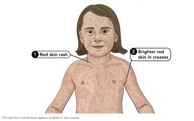 Симптоми на скарлатина при децата: Какво да очакваме