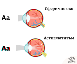 Астигматизъм: Какво представлява и как да го коригираме